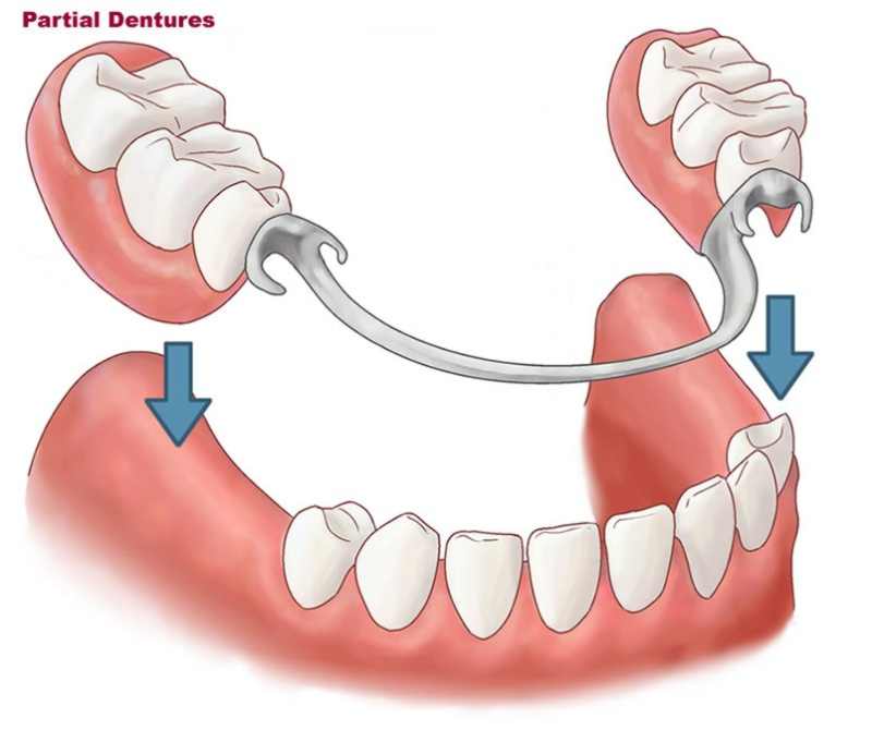 پروتز مصنوعی نیمه حاوی یک یا چند دندان مصنوعی است که در یک چهارچوب قرار میگیرد